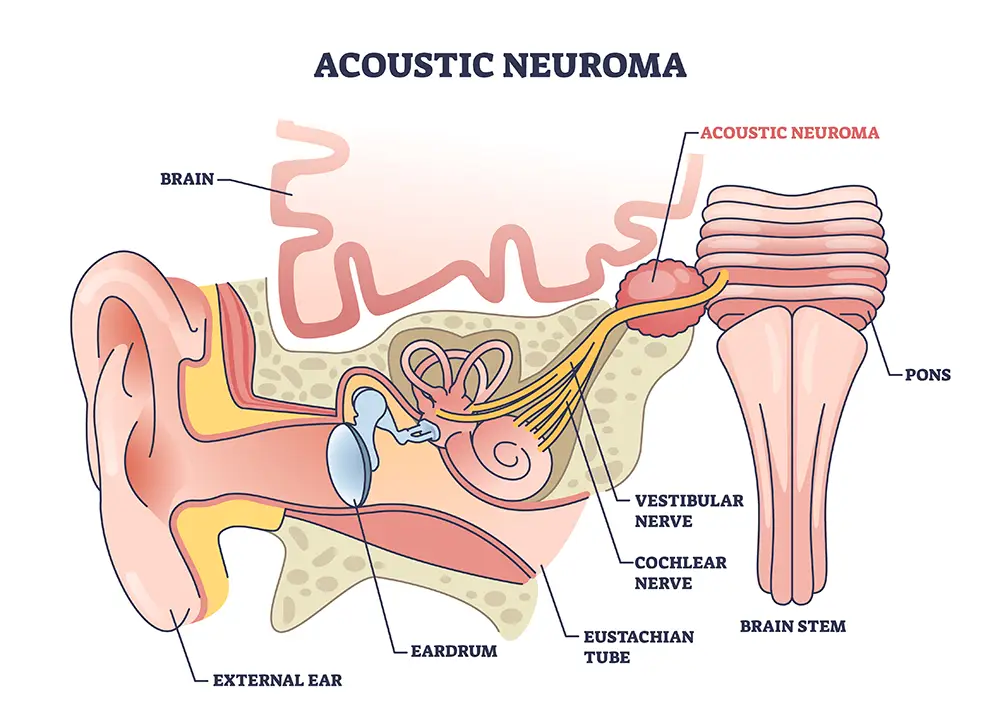 Illustration of an acoustic neuroma