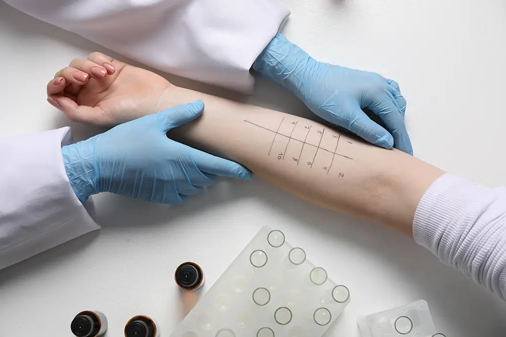 Photo of a doctor administering an allergy test