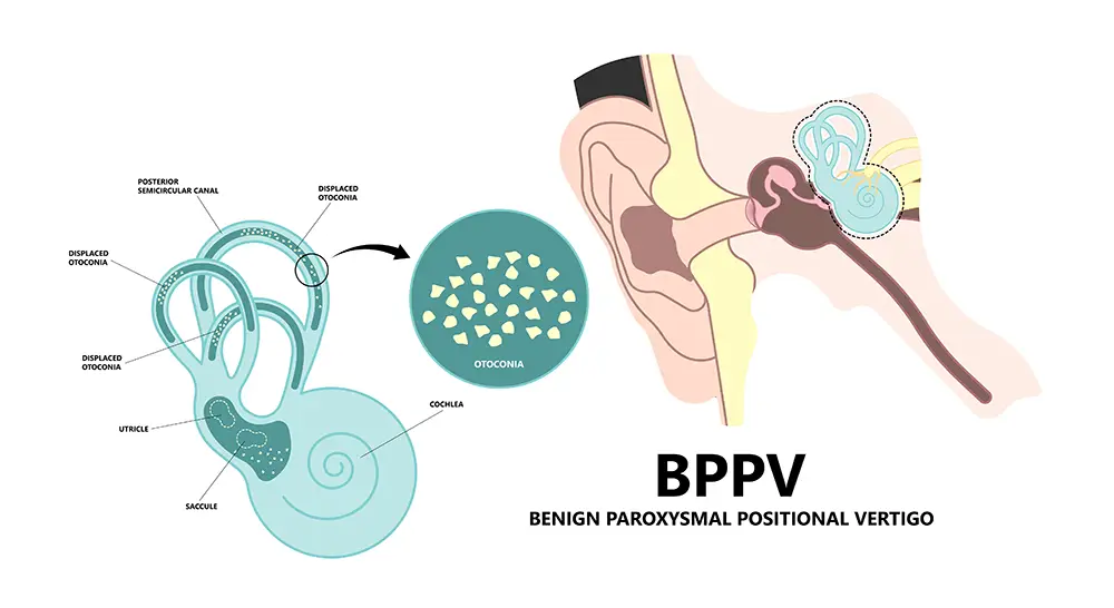 Illustration of BPPV