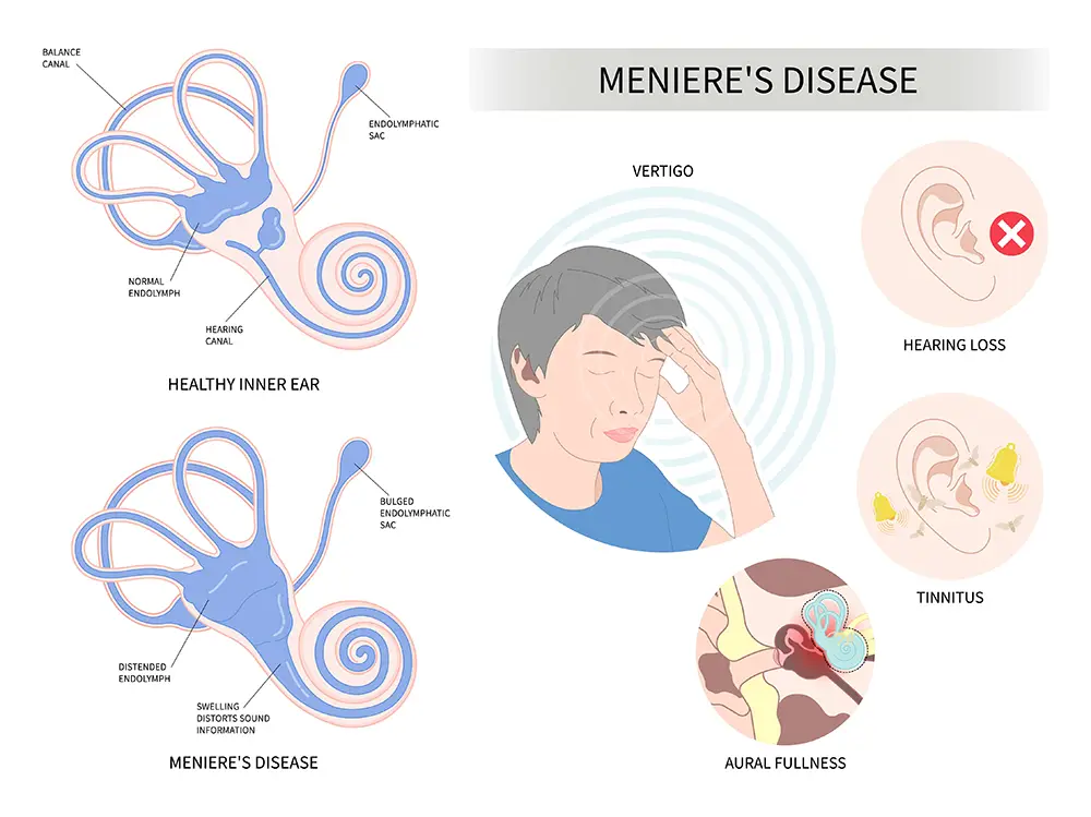 Illustration of Meniere's Disease