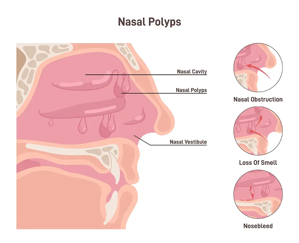 Illustration of Nasal Polyps