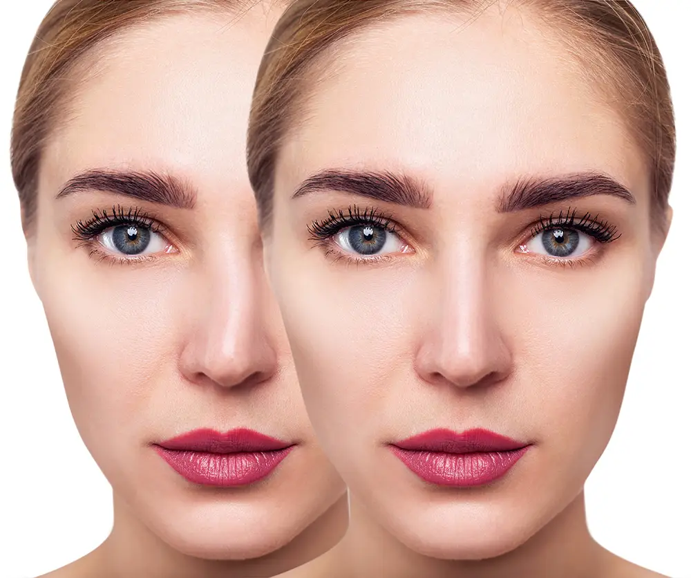 Before and after photos of a woman getting a surgery to correct a deviated septum