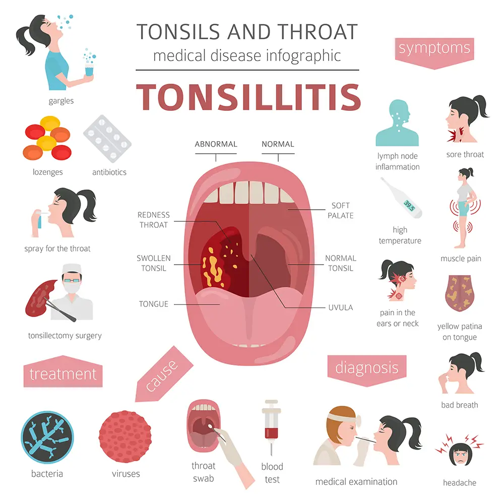 Graphic showing treatments and causes of tonsillitis