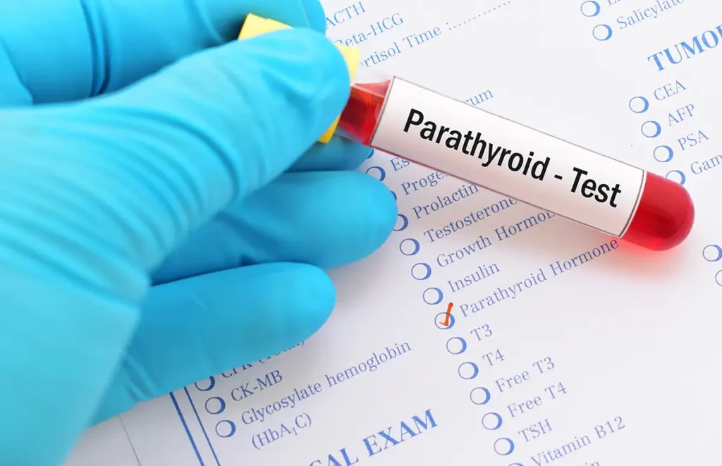 A vial with the label "Parathyroid - Test"